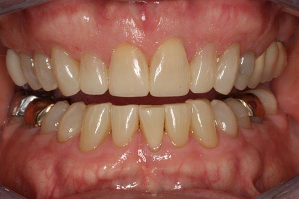 Pearls of Dentistry invisalign after — San Diego, CA