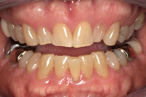 Invisalign before at Pearls of Dentistry in San Diego, CA