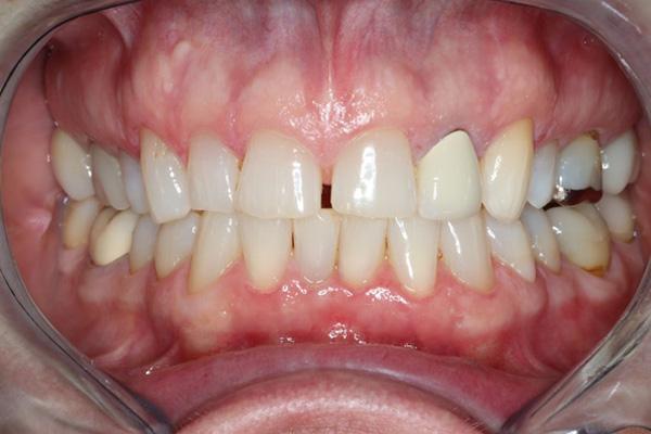 Pearls of Dentistry smile makeover after — San Diego, CA