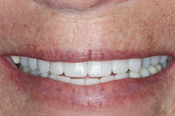 Pearls of Dentistry smile makeover after — San Diego, CA