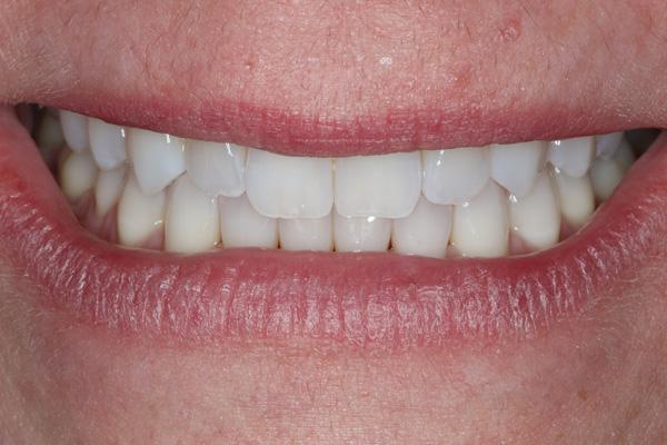 Pearls of Dentistry invisalign after — San Diego, CA