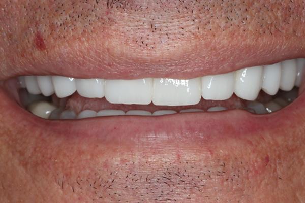 Pearls of Dentistry smile makeover after — San Diego, CA