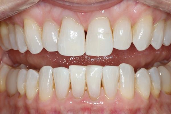 Smile Makeover after at Pearls of Dentistry in San Diego, CA