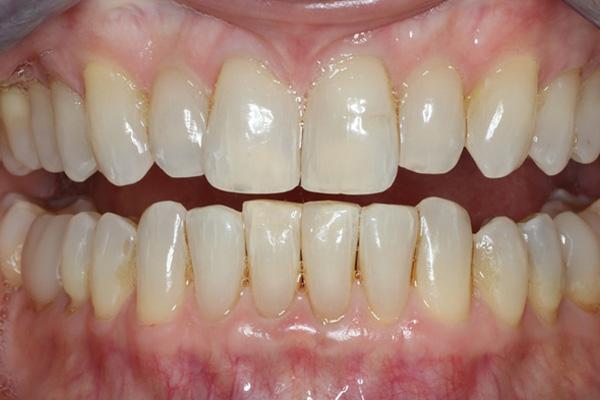 Smile Makeover before at Pearls of Dentistry in San Diego, CA