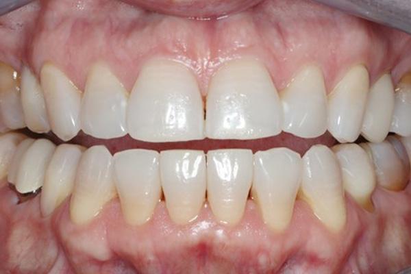 Pearls of Dentistry smile makeover after — San Diego, CA