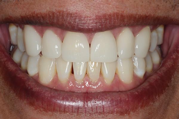 Invisalign after at Pearls of Dentistry in San Diego, CA