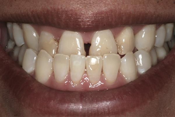 Invisalign before at Pearls of Dentistry in San Diego, CA