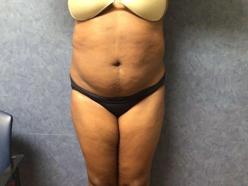 Plastic Surgery of Palm Beach liposuction after — West Palm Beach, FL