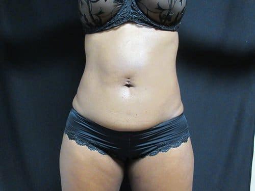 Plastic Surgery of Palm Beach liposuction after — West Palm Beach, FL