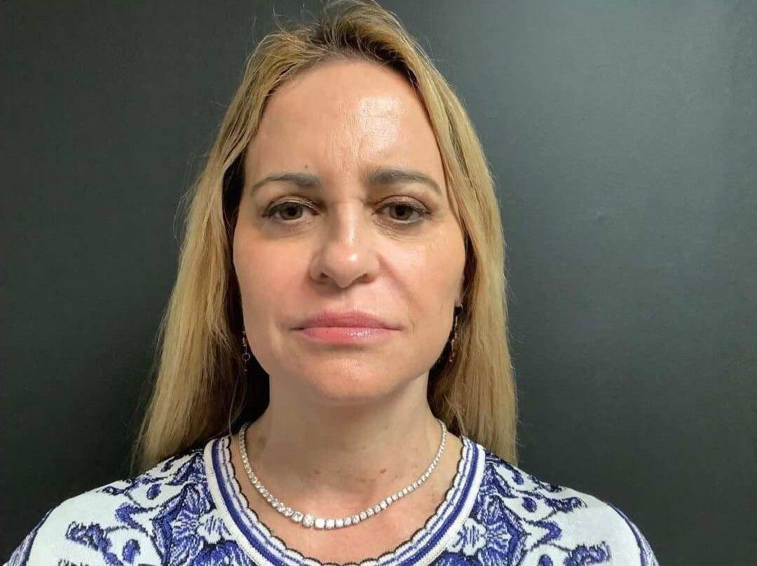 Plastic Surgery of Palm Beach facelift after — West Palm Beach, FL