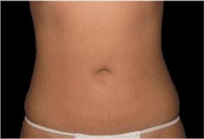 Plastic Surgery of Palm Beach liposuction after — West Palm Beach, FL