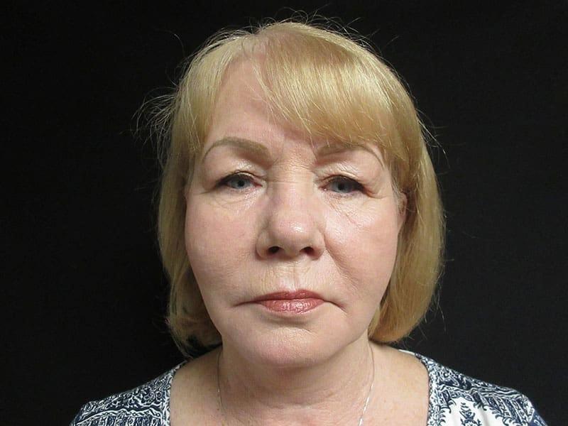 Plastic Surgery of Palm Beach facelift after — West Palm Beach, FL