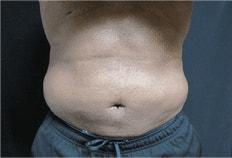Plastic Surgery of Palm Beach liposuction after — West Palm Beach, FL