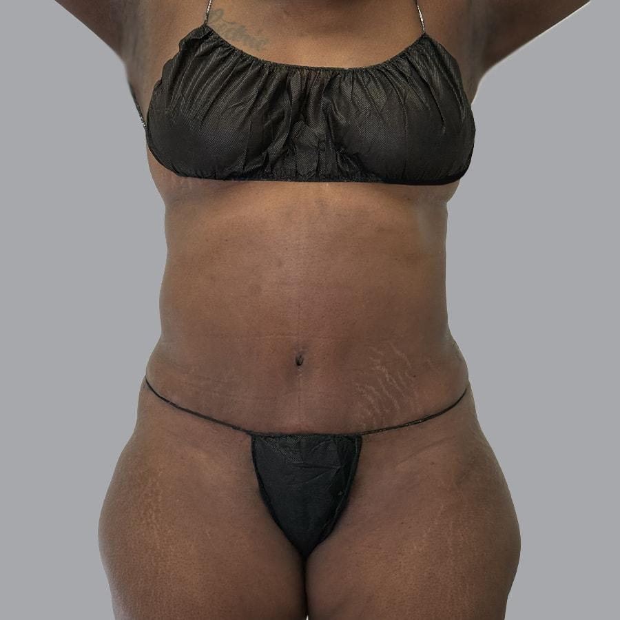 Alexey Markelov, MD tummy tuck after — Tampa, FL