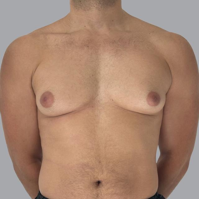 Gynecomastia Surgery before at Alexey Markelov, MD in Tampa, FL