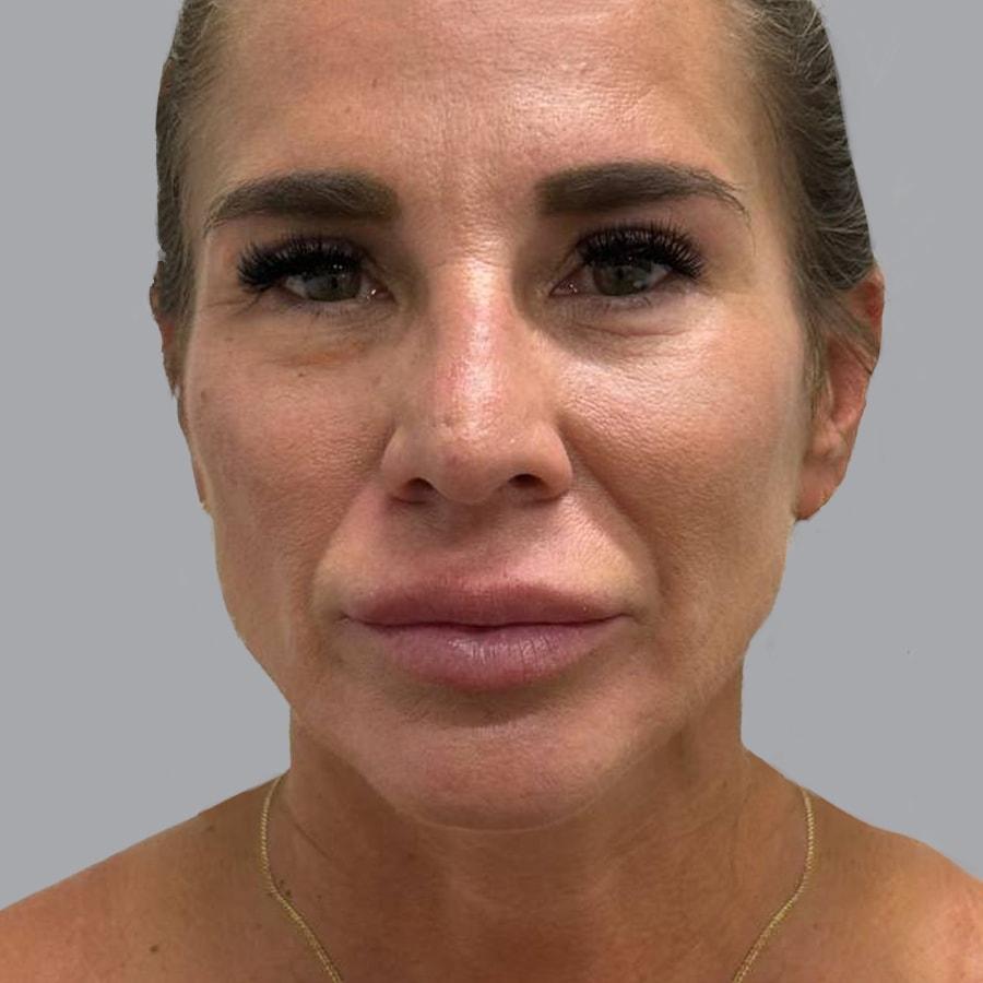 Alexey Markelov, MD eyelid lift after — Tampa, FL