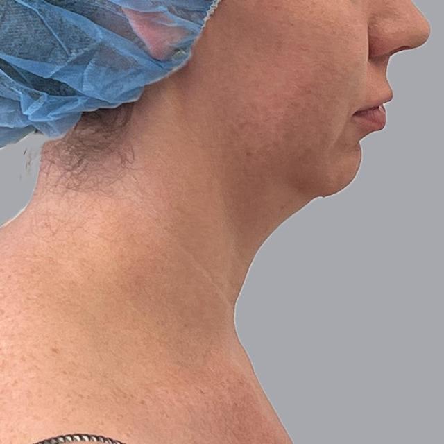 Neck Liposuction before at Alexey Markelov, MD in Tampa, FL