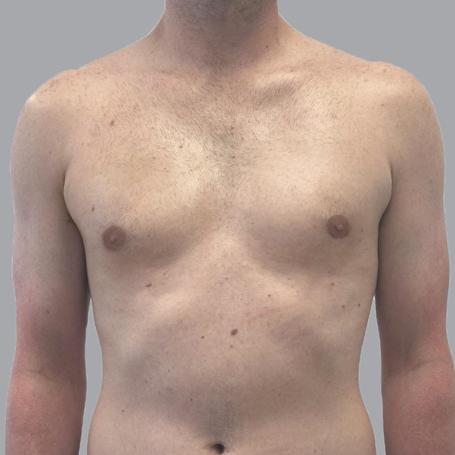 Alexey Markelov, MD gynecomastia after — Tampa, FL