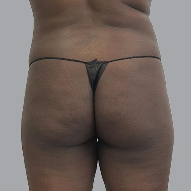 Brazilian Butt Lift before at Alexey Markelov, MD in Tampa, FL