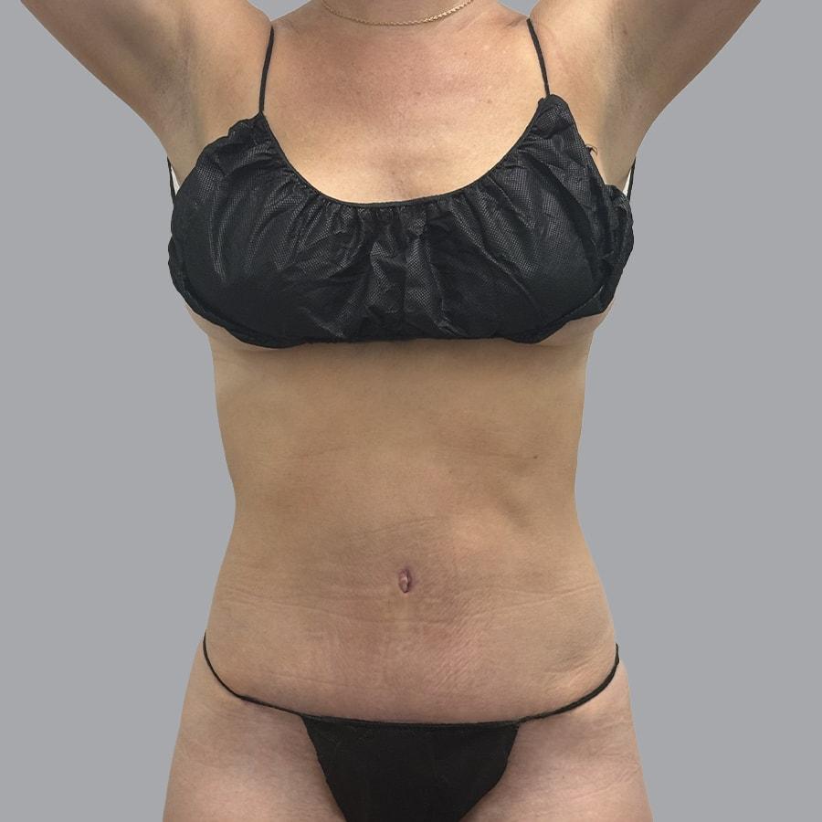 Alexey Markelov, MD tummy tuck after — Tampa, FL