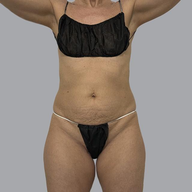 Mini Tummy Tuck before at Alexey Markelov, MD in Tampa, FL