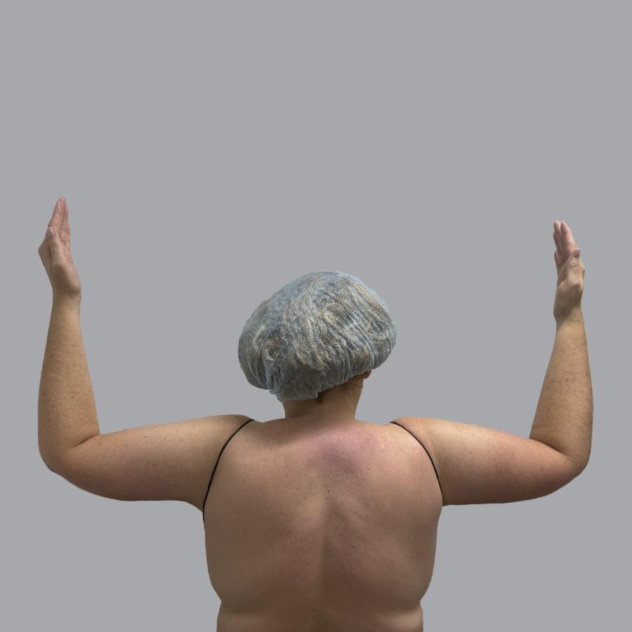 Alexey Markelov, MD arm lift after — Tampa, FL