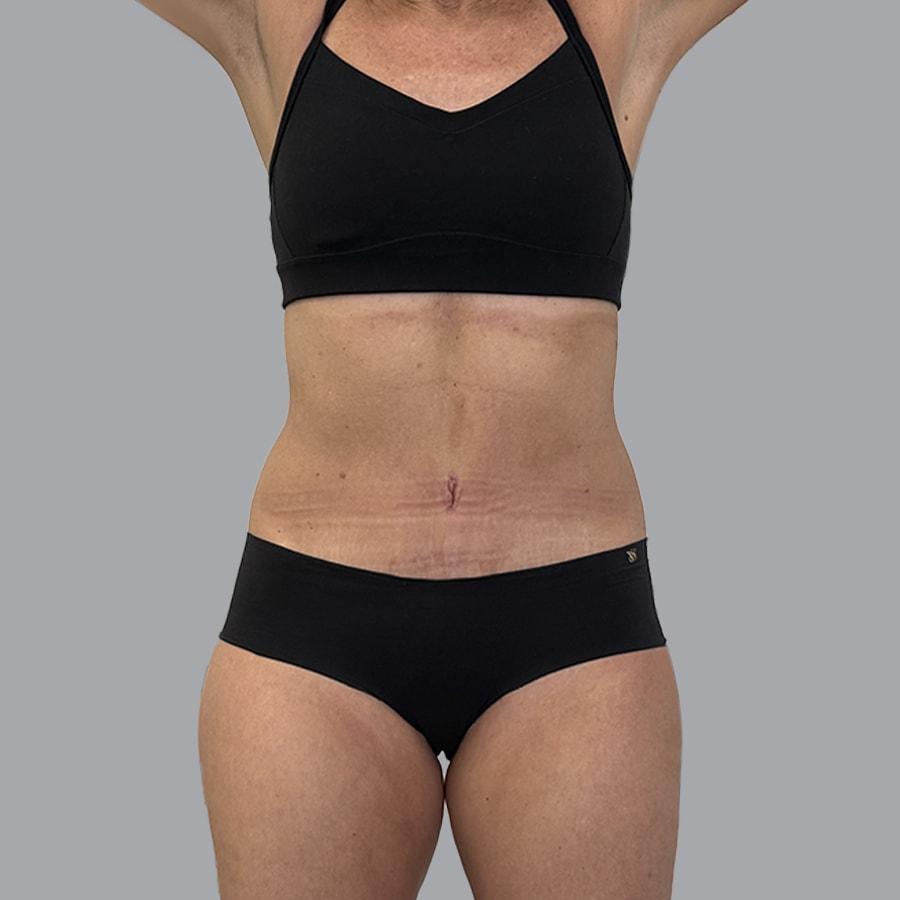 Alexey Markelov, MD tummy tuck after — Tampa, FL