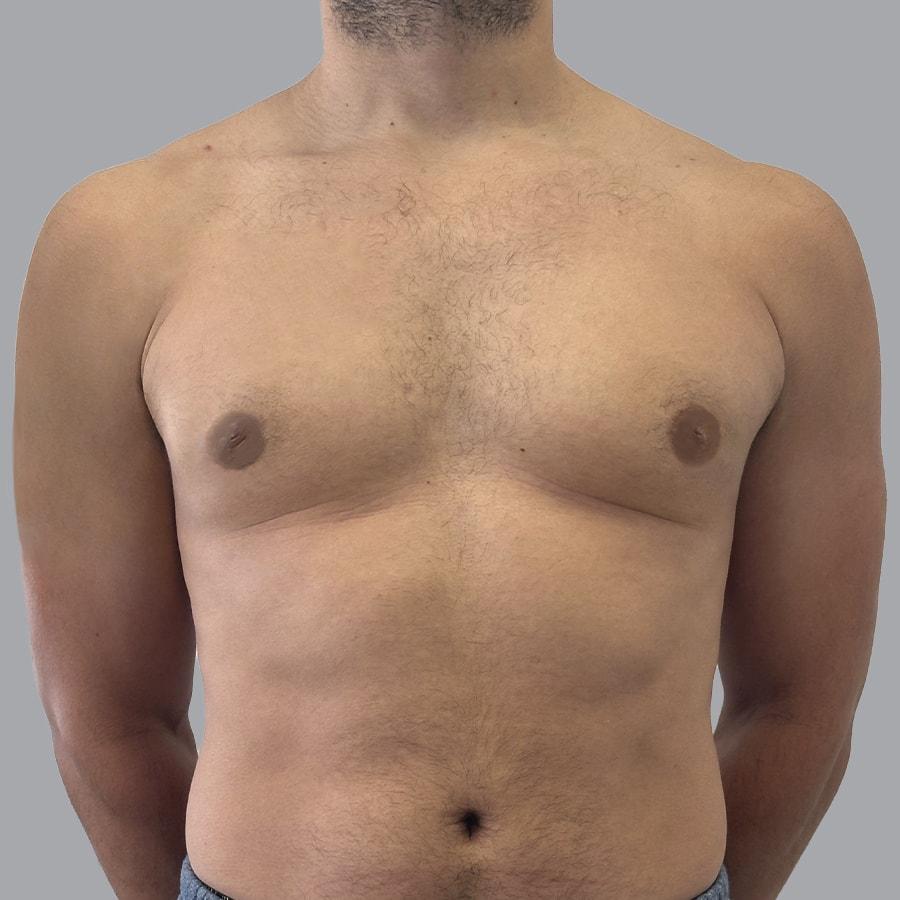 Alexey Markelov, MD gynecomastia after — Tampa, FL