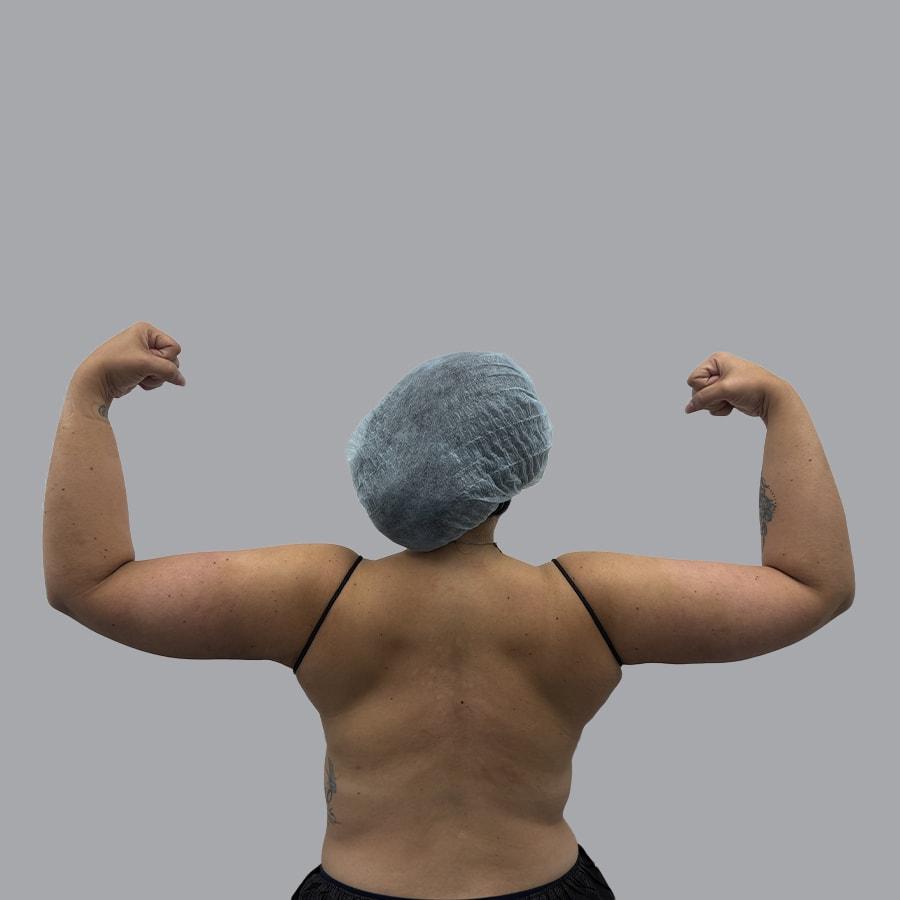 Alexey Markelov, MD arm lift after — Tampa, FL