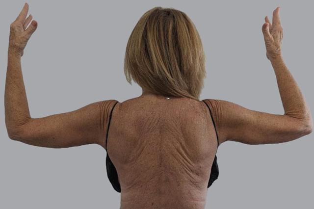 Arm Lift after at Alexey Markelov, MD in Tampa, FL