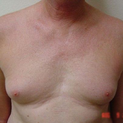 Liposuction before at Dr. Larry H. Pollack in San Diego, CA