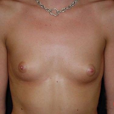 Breast Augmentation before at Dr. Larry H. Pollack in San Diego, CA