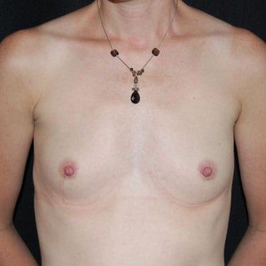 Breast Augmentation before at Dr. Larry H. Pollack in San Diego, CA