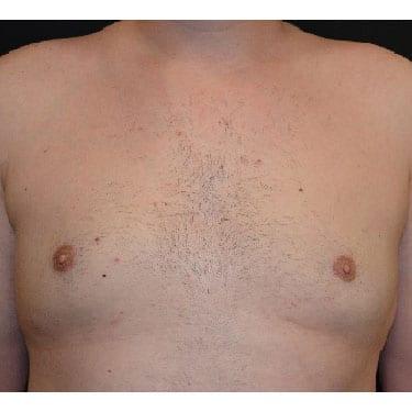 Liposuction after at Dr. Larry H. Pollack in San Diego, CA