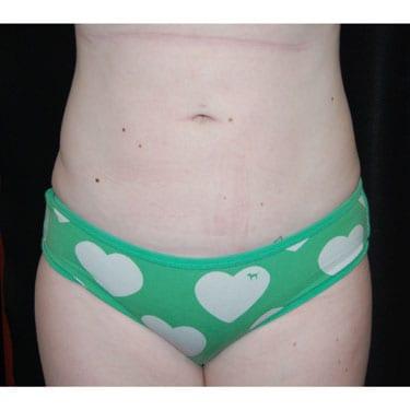 Dr. Larry H. Pollack liposuction after — San Diego, CA