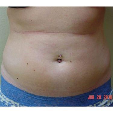 Liposuction before at Dr. Larry H. Pollack in San Diego, CA