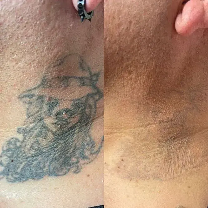 ReJuvU Beauty Haven laser treatment result — West Point, UT