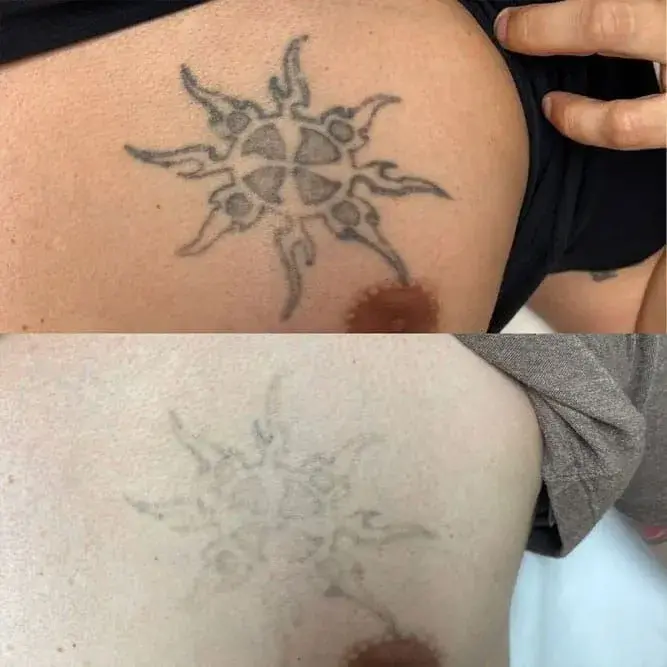 ReJuvU Beauty Haven laser treatment result — West Point, UT