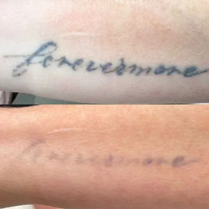 ReJuvU Beauty Haven laser treatment result — West Point, UT