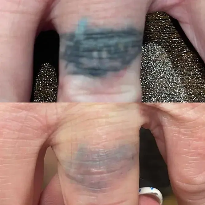 ReJuvU Beauty Haven laser treatment result — West Point, UT