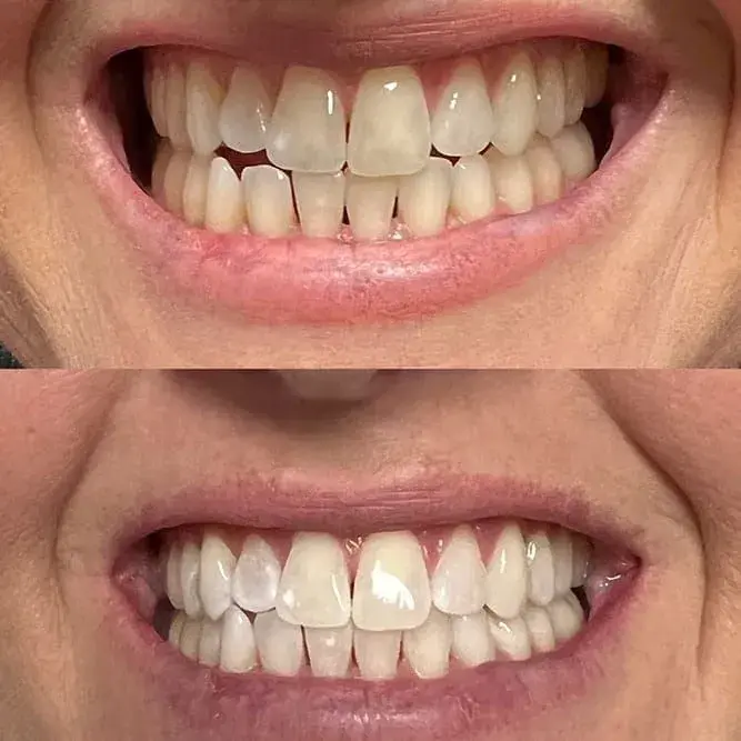 ReJuvU Beauty Haven teeth whitening result — West Point, UT