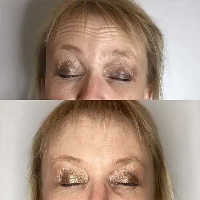Botox result at ReJuvU Beauty Haven in West Point, UT