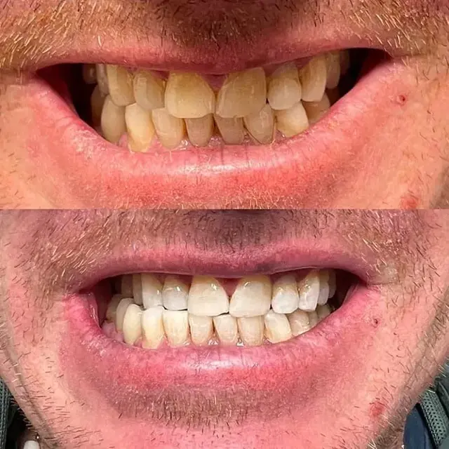Teeth Whitening result at ReJuvU Beauty Haven in West Point, UT