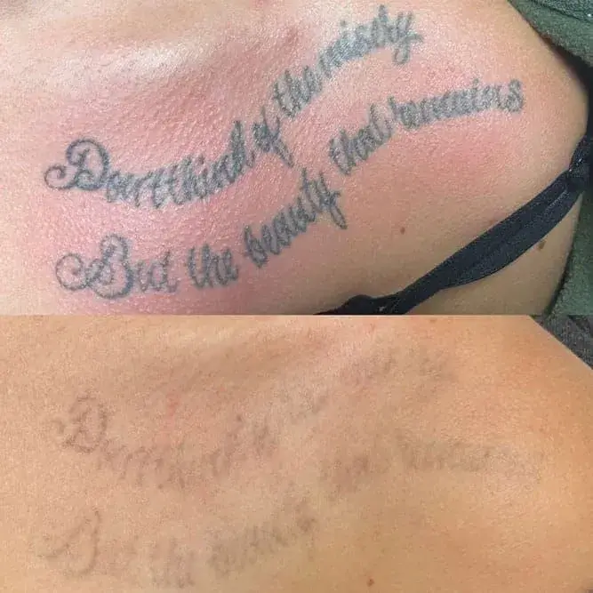 ReJuvU Beauty Haven laser treatment result — West Point, UT