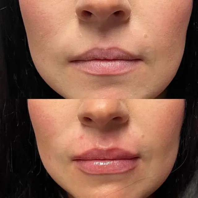 Lip Filler result at ReJuvU Beauty Haven in West Point, UT