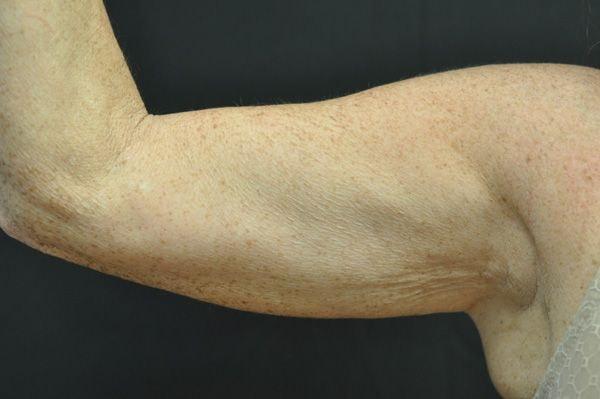 CoolSculpting before at Andrew Smith, MD, FACS in Irvine, CA