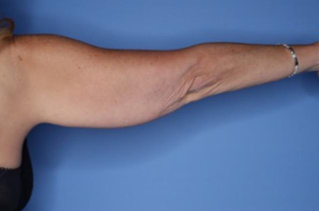 Arm Lift before at Andrew Smith, MD, FACS in Irvine, CA