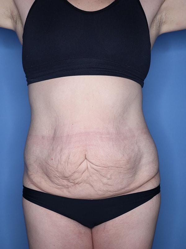 Tummy Tuck before at Andrew Smith, MD, FACS in Irvine, CA