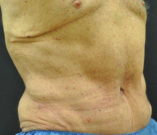 Tummy Tuck after at Andrew Smith, MD, FACS in Irvine, CA