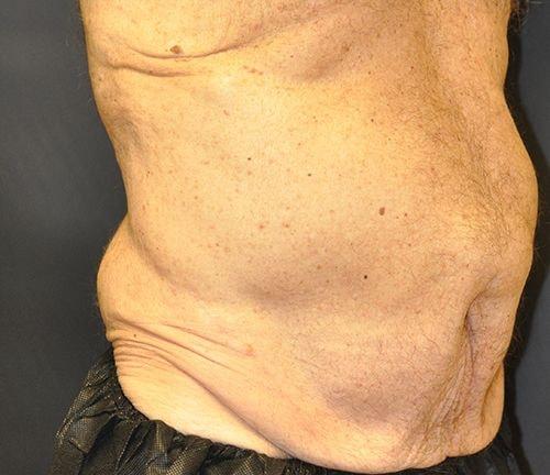 Tummy Tuck before at Andrew Smith, MD, FACS in Irvine, CA